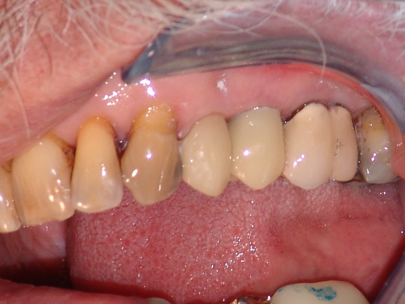 After-Implant Restoration