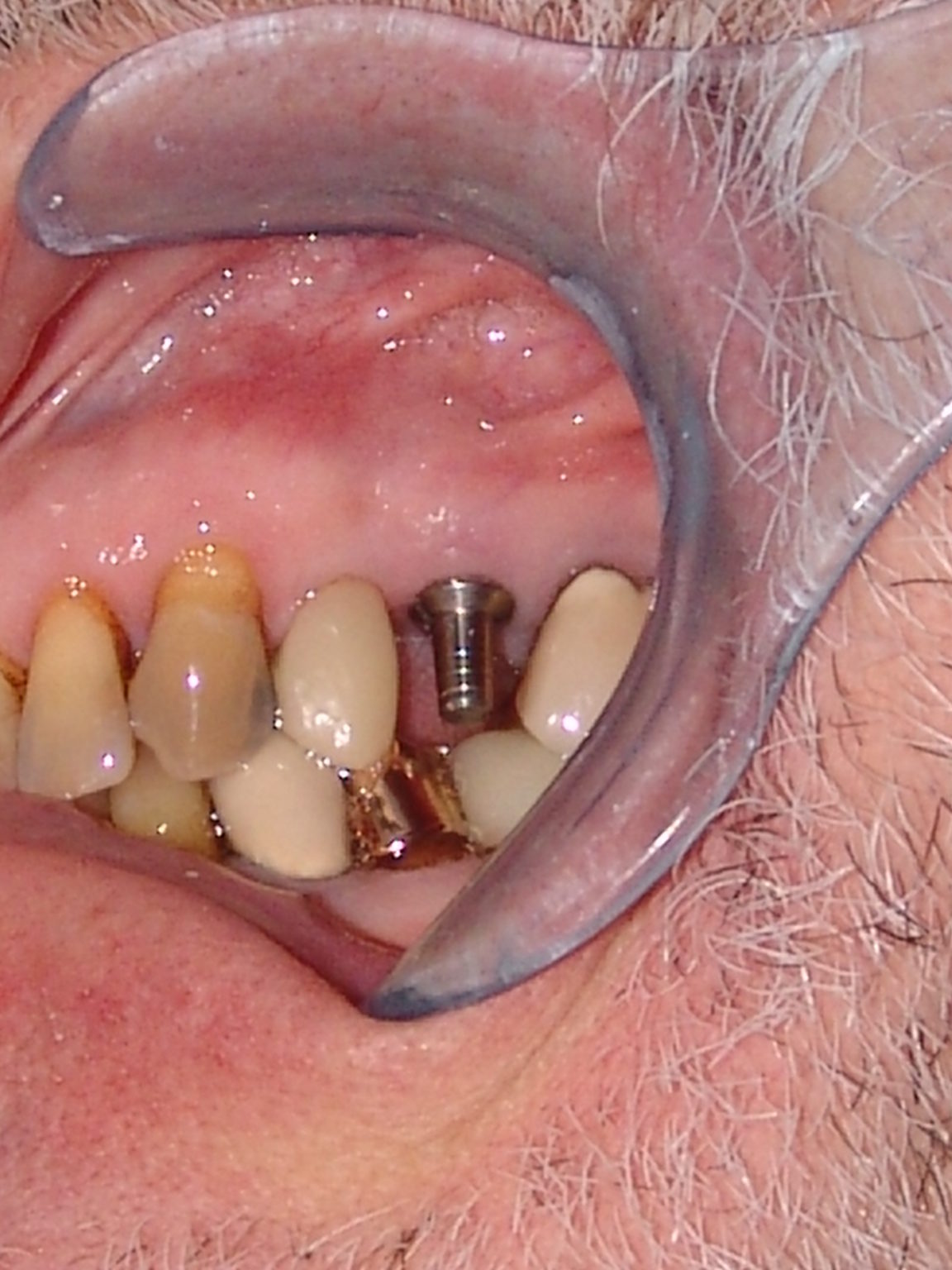 Before-Implant Restoration