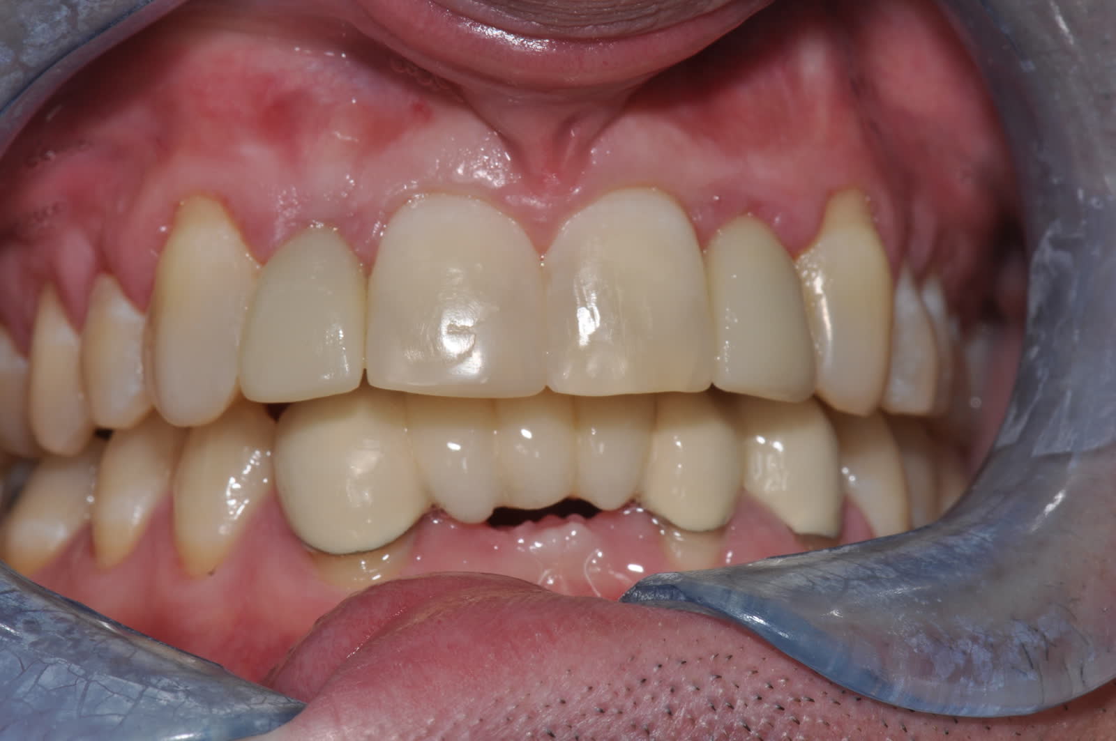 After-Ortho and Implants