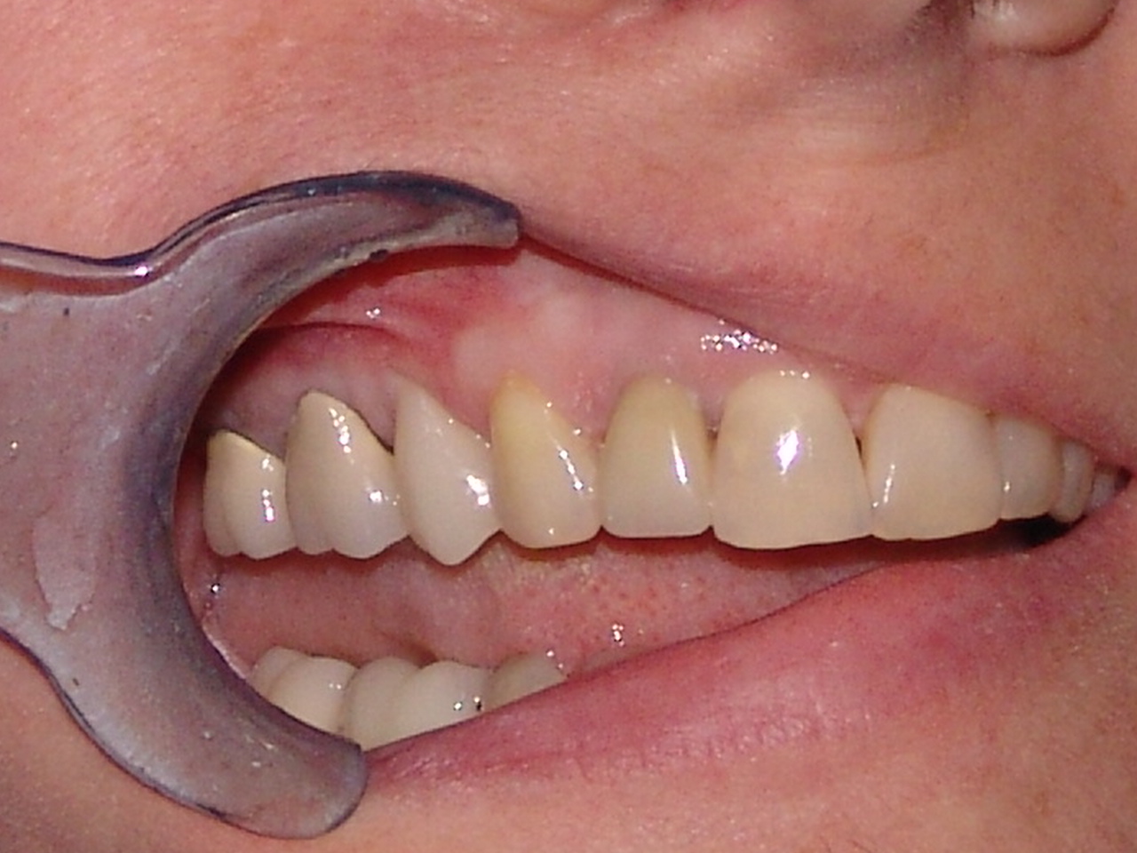 After-posterior emax