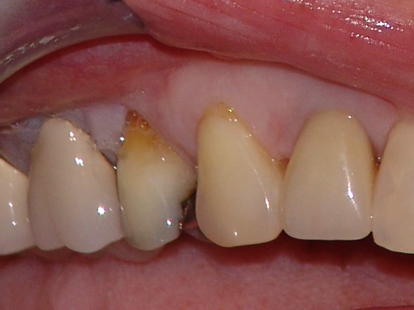 Before-posterior emax